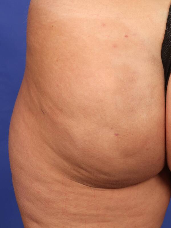 Fat Grafting Before & After Image