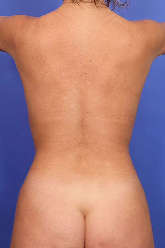 Liposuction Before & After Image