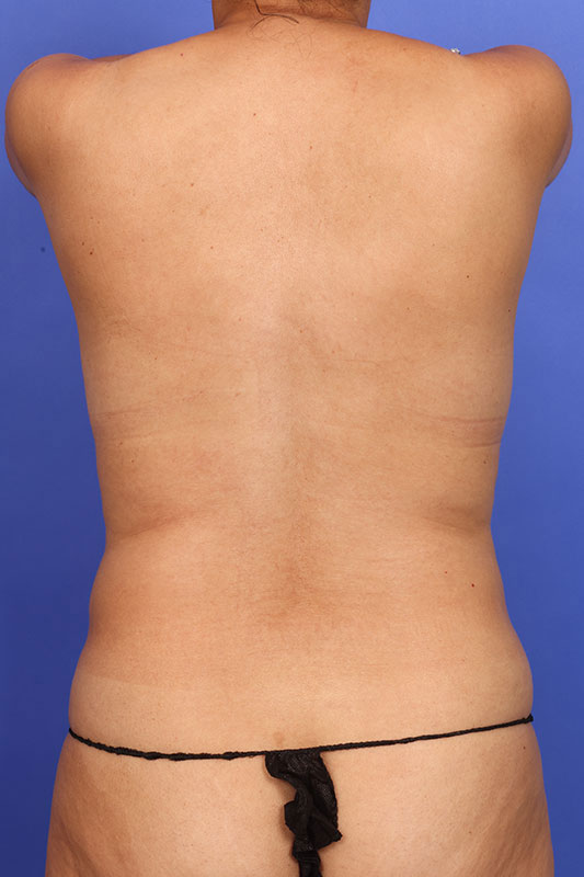 Liposuction Before & After Image