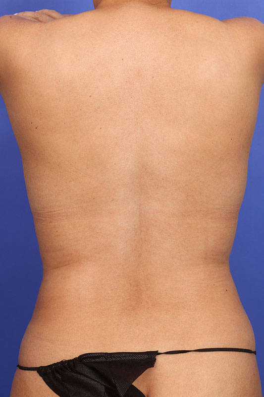 Liposuction Before & After Image