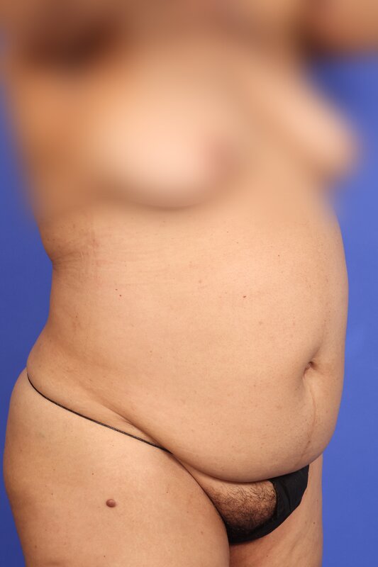 Liposuction Before & After Image