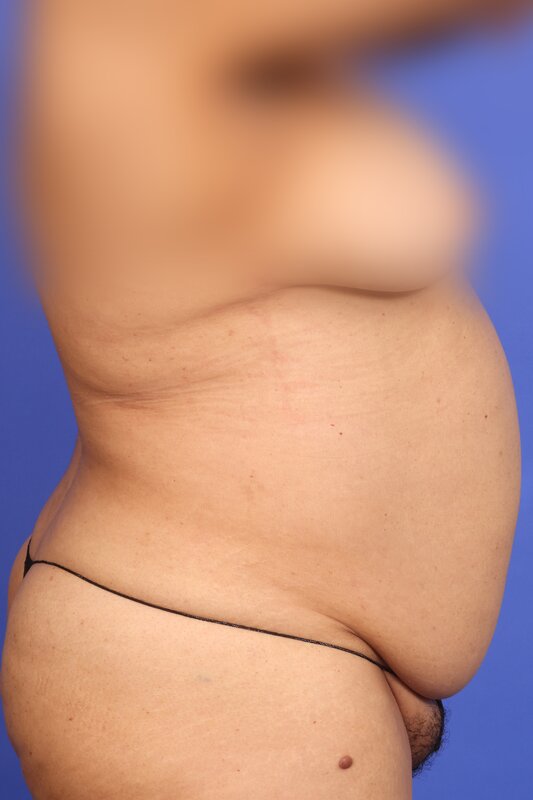 Liposuction Before & After Image