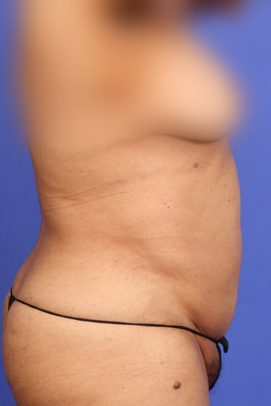 Liposuction Before & After Image