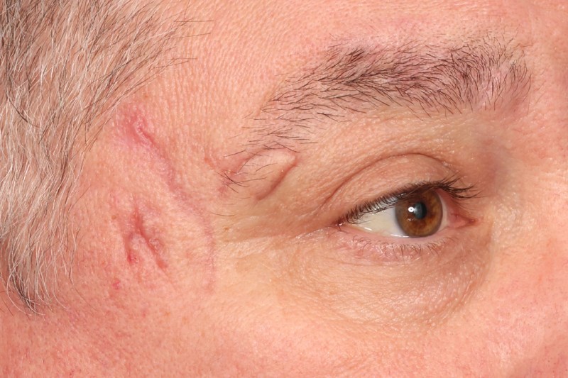 Scar Revision Before & After Image