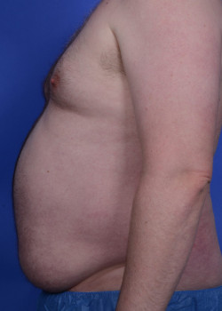 SmartLipo Before & After Image