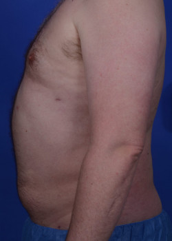 SmartLipo Before & After Image