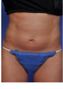 SmartLipo Before & After Image