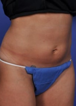 SmartLipo Before & After Image