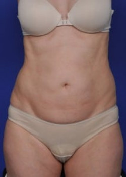 SmartLipo Before & After Image