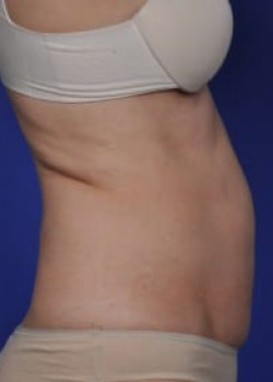 SmartLipo Before & After Image