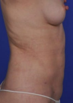 SmartLipo Before & After Image