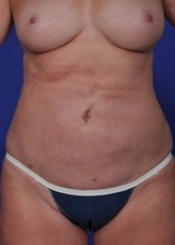 SmartLipo Before & After Image