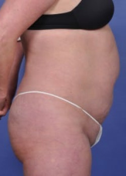 SmartLipo Before & After Image