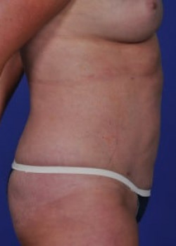 SmartLipo Before & After Image