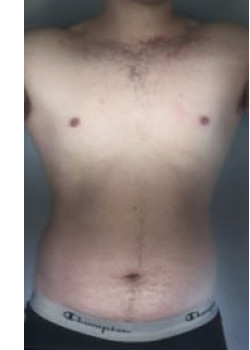 SmartLipo Before & After Image