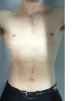 SmartLipo Before & After Image