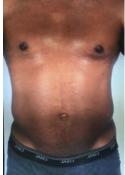 SmartLipo Before & After Image