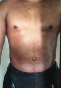 SmartLipo Before & After Image