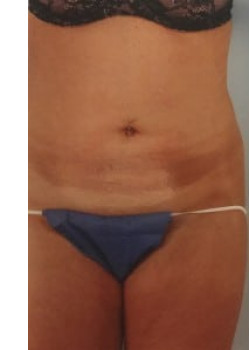 SmartLipo Before & After Image