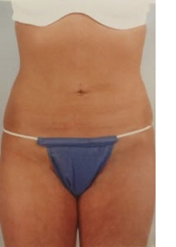 SmartLipo Before & After Image