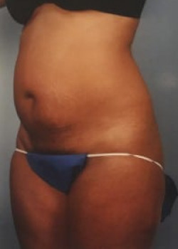 SmartLipo Before & After Image