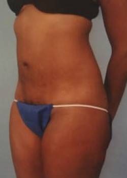 SmartLipo Before & After Image