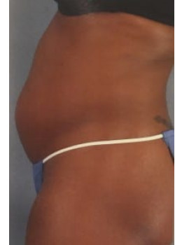 SmartLipo Before & After Image