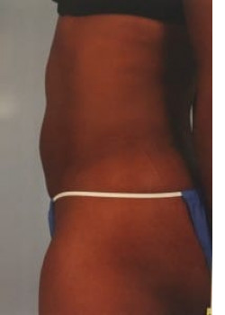 SmartLipo Before & After Image