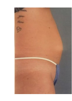 SmartLipo Before & After Image