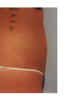 SmartLipo Before & After Image