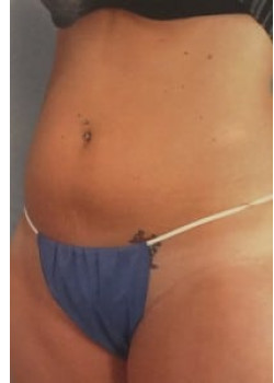 SmartLipo Before & After Image