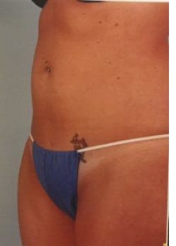 SmartLipo Before & After Image