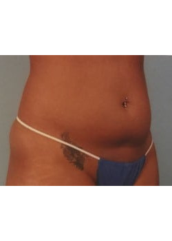 SmartLipo Before & After Image