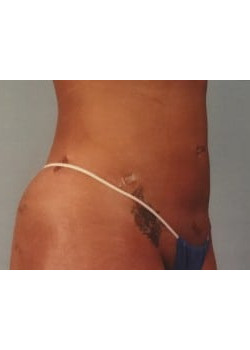 SmartLipo Before & After Image