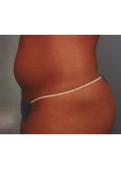 SmartLipo Before & After Image