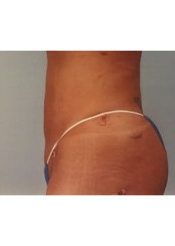 SmartLipo Before & After Image