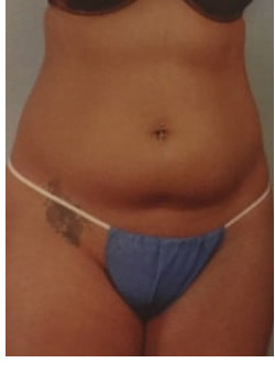 SmartLipo Before & After Image