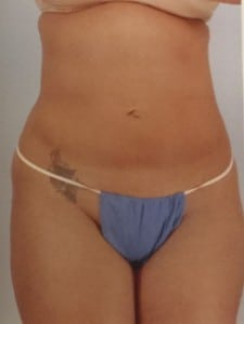 SmartLipo Before & After Image