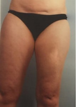 SmartLipo Before & After Image