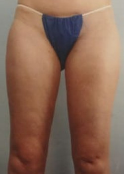 SmartLipo Before & After Image