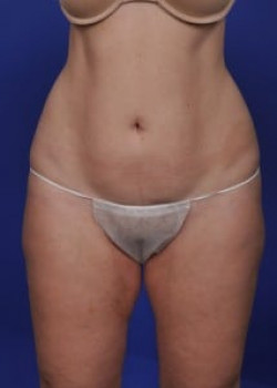 SmartLipo Before & After Image