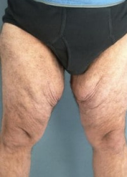 Thigh Lift Before & After Image