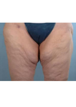 Thigh Lift Before & After Image