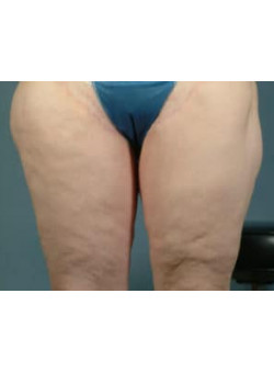 Thigh Lift Before & After Image