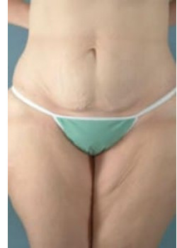 Tummy Tuck Before & After Image