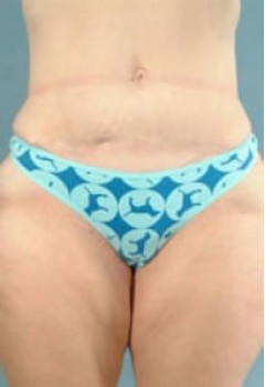 Tummy Tuck Before & After Image