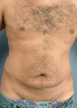 Tummy Tuck Before & After Image