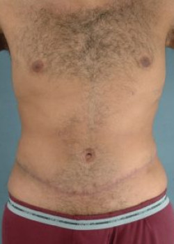 Abdominoplasty (Tummy Tuck) Before & After Image