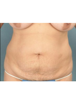 Tummy Tuck Before & After Image