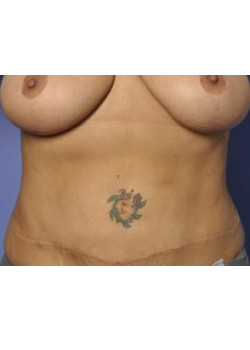 Tummy Tuck Before & After Image